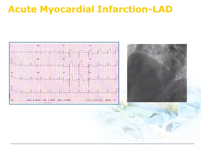 Acute Myocardial Infarction-LAD